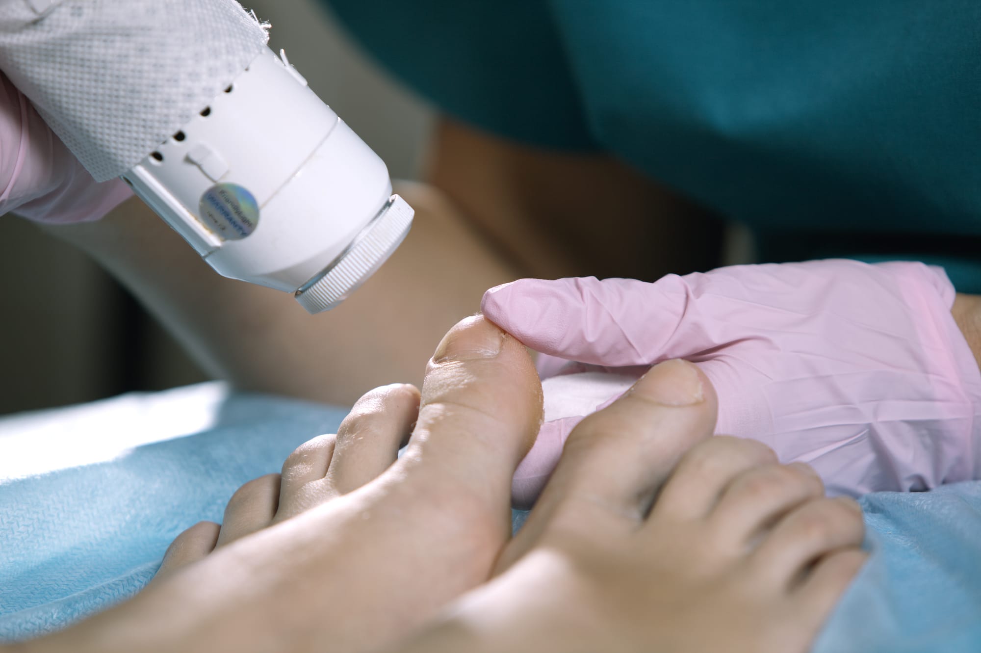 Toenail fungal laser therapy