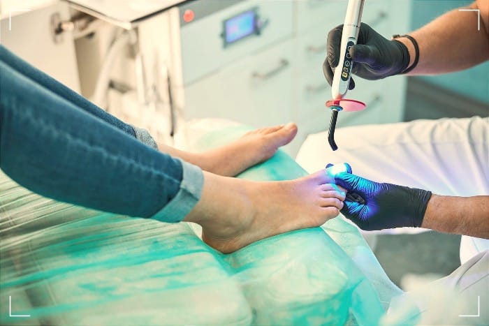 Laser Treatments for Fungal Infections in the Toenails