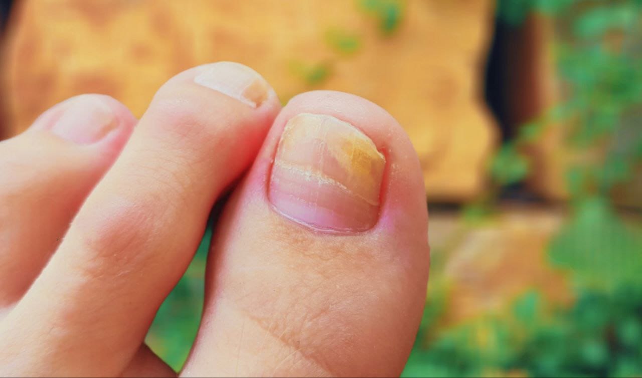 Toe Nail Fungus 