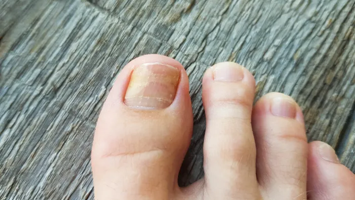 Toenail Infections